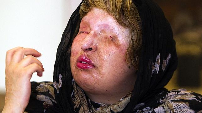 La iraní que quedó ciega tras ser rociada con ácido perdona a su agresor