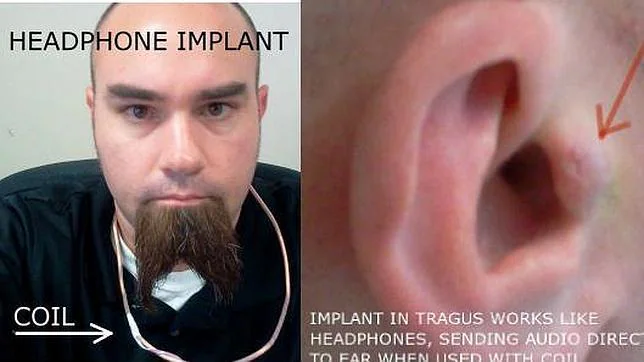 Se implanta auriculares en los oídos para probar que tienen «cientos de ventajas»