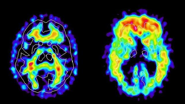Diagnostican el Alzheimer con ayuda de la tecnología espacial