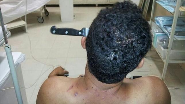 Un hombre llega a pie a un hospital de Brasil con un cuchillo clavado en la cabeza