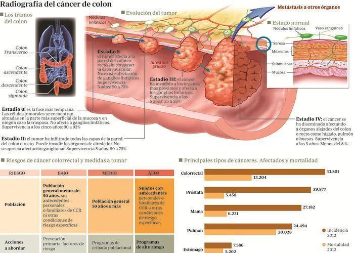 El cáncer de colon se puede curar si se detecta a tiempo 