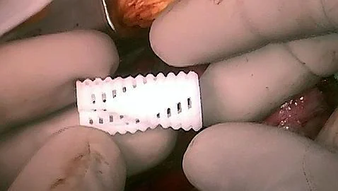 Un implante fabricado con un impresora 3D cura una enfermedad incurable