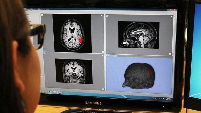 Un software español facilita el diagnóstico precoz de alzhéimer o párkinson