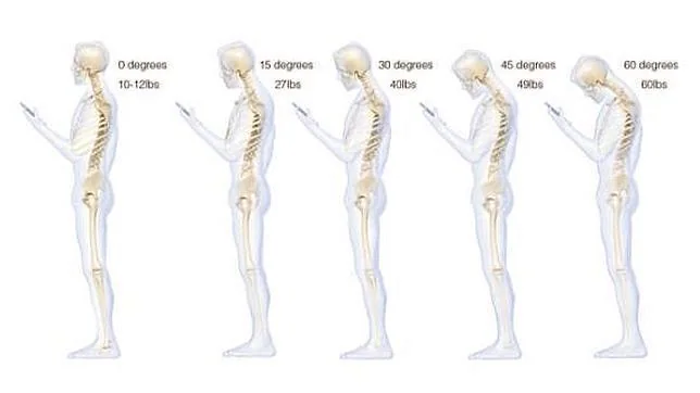 El síndrome del cuello roto por culpa de los «smartphones»