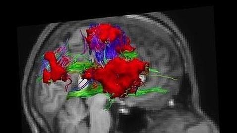 Dibujan un nuevo atlas del cerebro clave para estudiar el alzhéimer o el párkinson