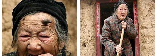 A una anciana china le crece un cuerno negro de seis centímetros en la frente | Noticias de Buenaventura, Colombia y el Mundo
