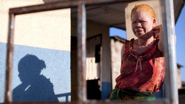 Malawi, el país en que los albinos viven con miedo a ser torturados, asesinados y descuartizados