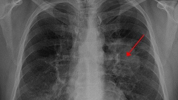 Radiografia de paciente con ca ncer de pulmó