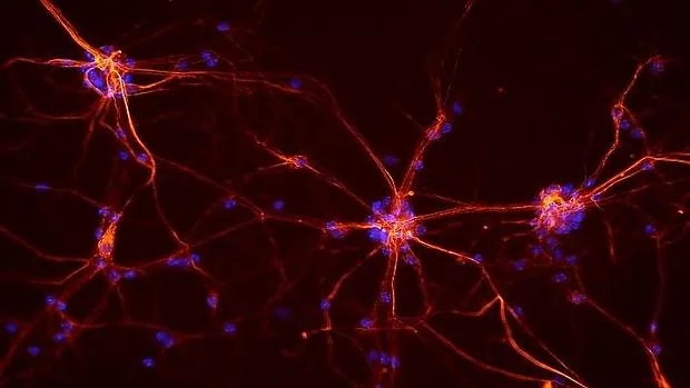 La esclerosis múltiple causa la pérdida de la capa de mielina de las neuronas