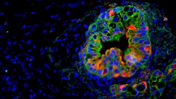 Expresión del gen 'Musashi' (en verde) en células humanas de cáncer de páncreas