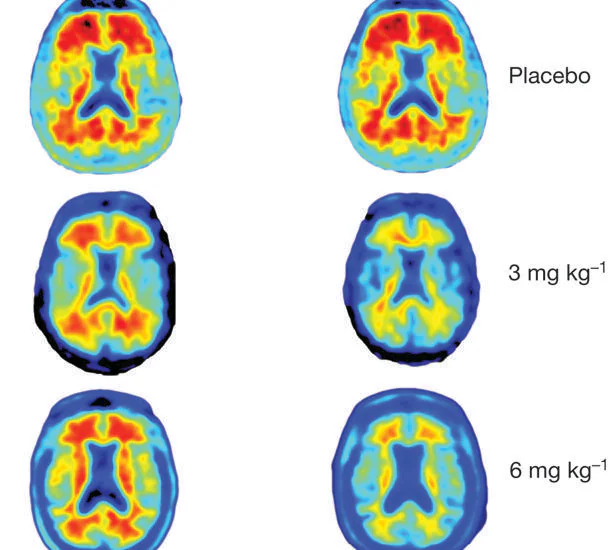 Una terapia detiene el deterioro cognitivo asociado al alzhéimer en pacientes