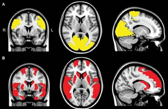 Disminución de la conectividad en los lóbulos paracentral y occipital en pacientes con alucinaciones visuales (abajo)