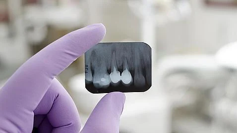 Clínica dental Boca&Boca Málaga Implantes dentales ¿Son todos iguales?