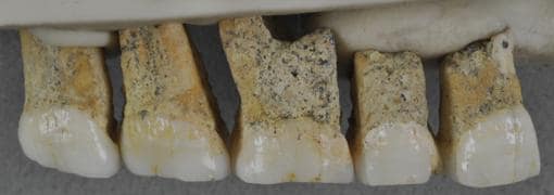 Dientes superiores derechos de un Homo luzonensis. De izquierda a derecha: dos premolares y tres molares