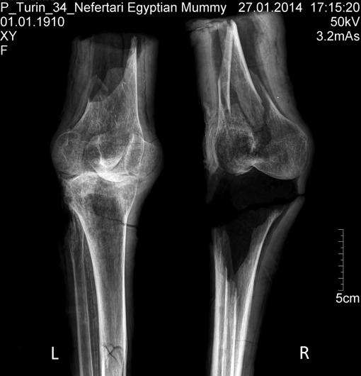 Radiografía de las piernas momificadas con algún rastro de Artritis