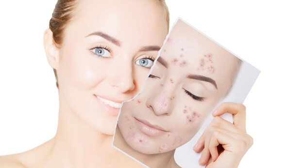 Resultado de imagen para acne