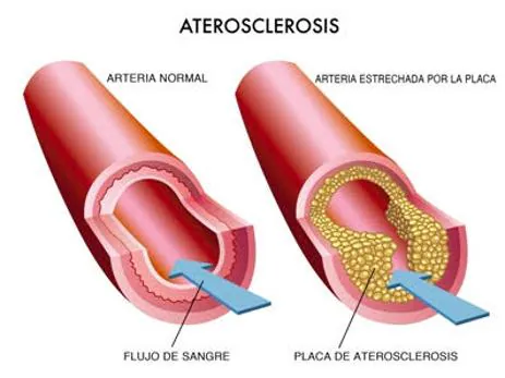 Resultado de imagen de aterosclerosis