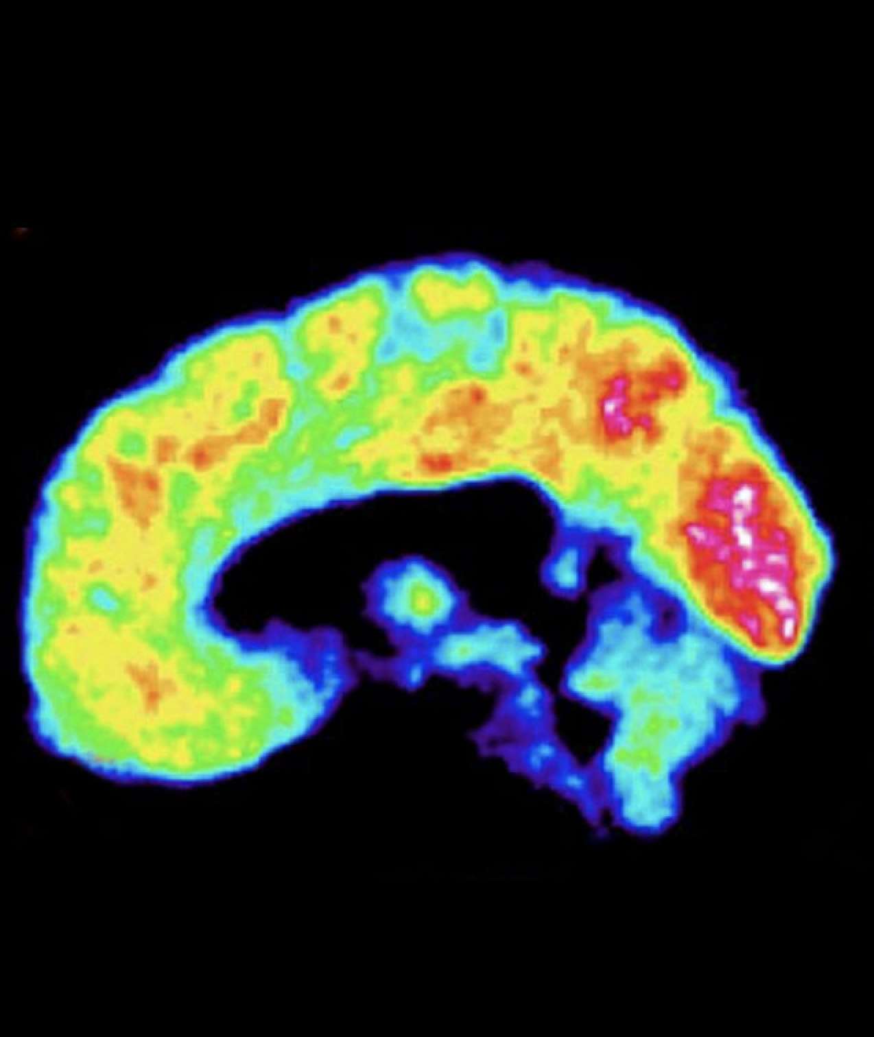 El cerebro de Putin: «Algo nuevo se ha activado en él hace poco»